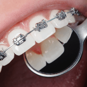 clinica-dental-santiago-de-compostela-ortodoncia