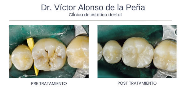 clinica-estetica-dental-galicia-caries-cuatro