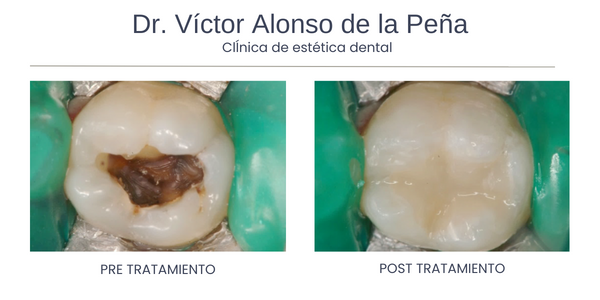 clinica-estetica-dental-galicia-caries-tres