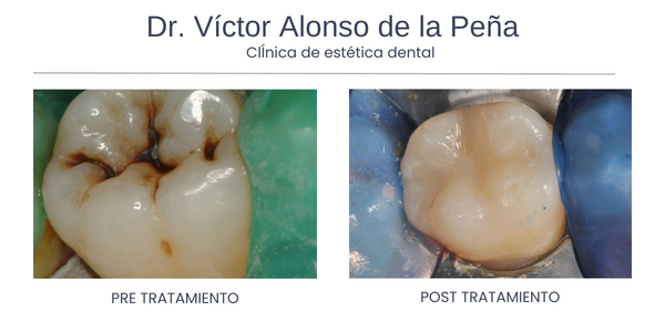 clinica-estetica-dental-galicia-caries-uno