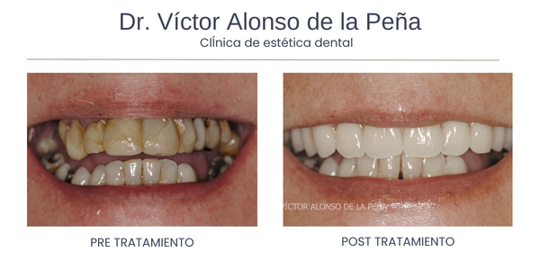 clinica-estetica-dental-galicia-implante-dos
