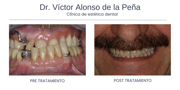 clinica-estetica-dental-galicia-implante-tres