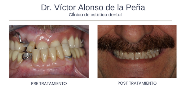 Corrección del Ronquido - Clínica Dental Víctor Alonso de la Peña