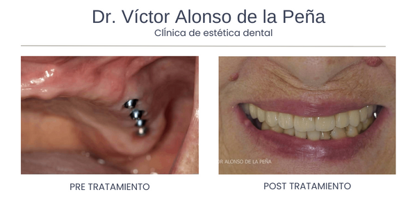 clinica-estetica-dental-galicia-implante-uno
