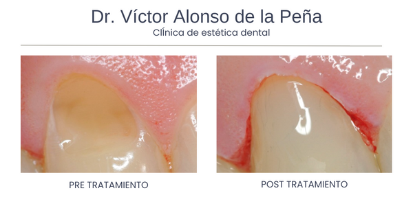 clinica-estetica-dental-galicia-lesiones-cuatro