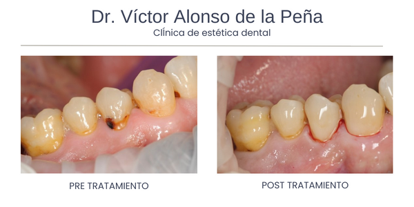 clinica-estetica-dental-galicia-lesiones-tres