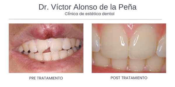 clinica-estetica-dental-galicia-trauma-uno