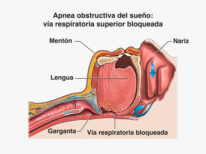 ferula-anti-ronquido-santiago-de-compostela-grafico