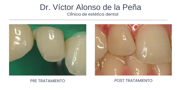 clinica-estetica-dental-galicia-carillas-cuatro