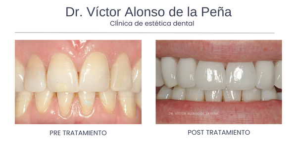 clinica-estetica-dental-galicia-carillas-uno