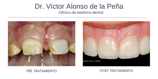 clinica-estetica-dental-galicia-coronas-cuatro