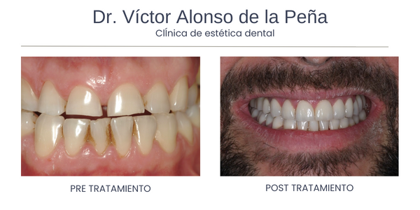 clinica-estetica-dental-galicia-coronas-tres