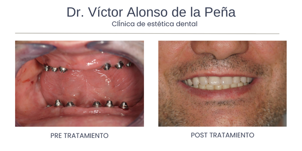 clinica-estetica-dental-galicia-implantes-cuatro