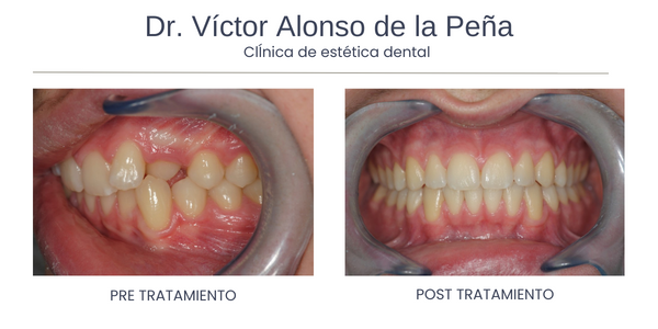clinica-estetica-dental-galicia-ortodoncia-tres