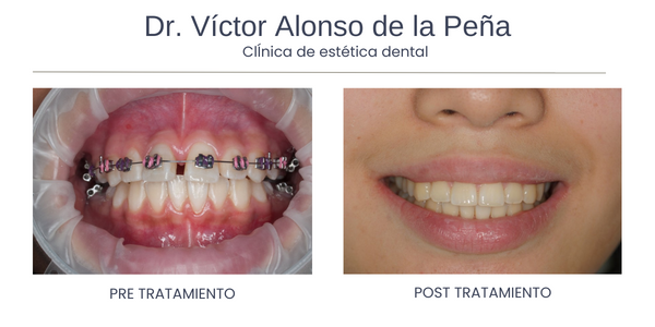 clinica-estetica-dental-galicia-ortodoncia-uno