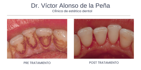 clinica-estetica-dental-galicia-periodoncia-dos