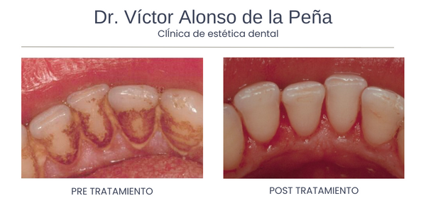 Corrección del Ronquido - Clínica Dental Víctor Alonso de la Peña