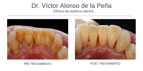 clinica-estetica-dental-galicia-periodoncia-uno