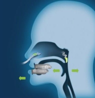 Anti-Ronquido. Dispositivo de Avance Mandibular para el Ronquido