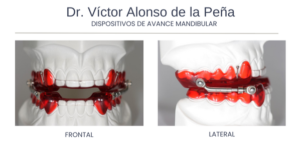 Apnea del sueño: tratamiento con férulas de avance mandibular