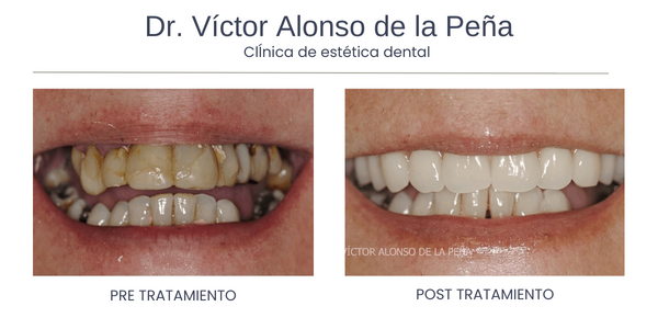 implantes-dentales-santiago-de-compostela-antes