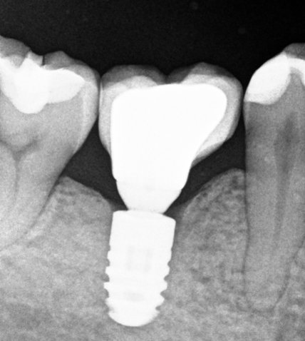 implantes-santiago-de-compsotela-radiografia