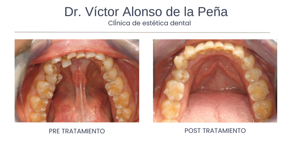 invisalign-santiago-de-compostela-