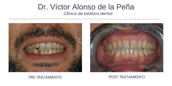 invisalign-santiago-de-compostela-uno