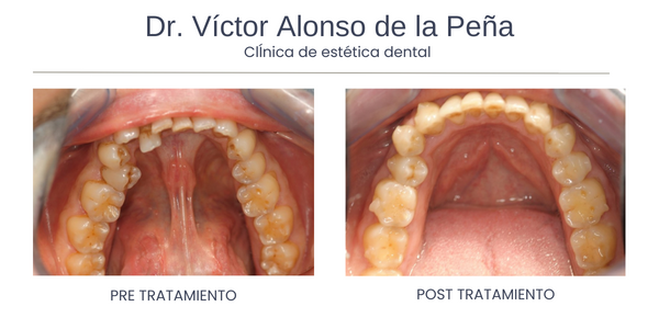 ortodoncia-santiago-de-compostela-tres