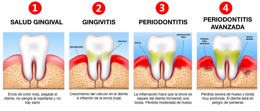 periodoncia-santiago-de-compostela-estados