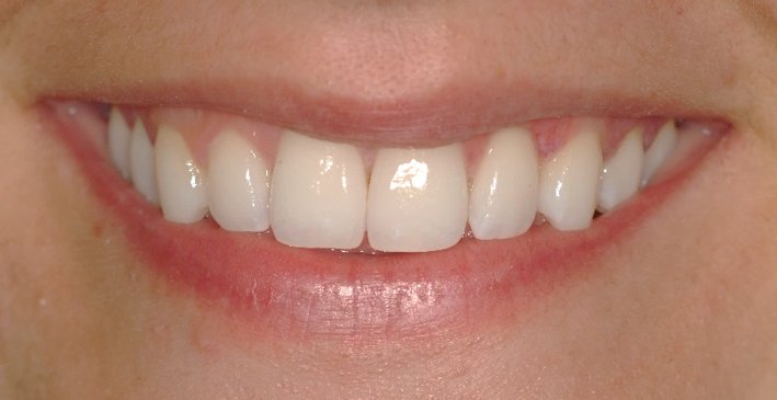 blanqueamiento-dental-santiago-de-compostela-sonrisa-blanca