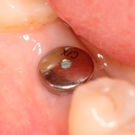 clinica-dental-santiago-de-compostela-implante