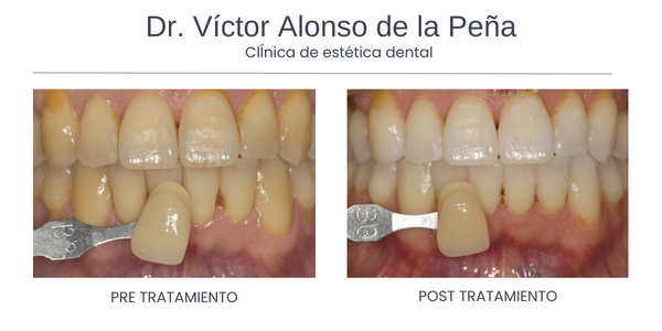 clinica-estetica-dental-galicia-blanqueamiento-cinco