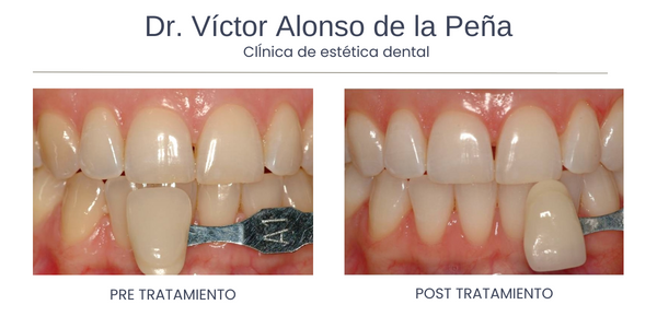 clinica-estetica-dental-galicia-blanqueamiento-diez
