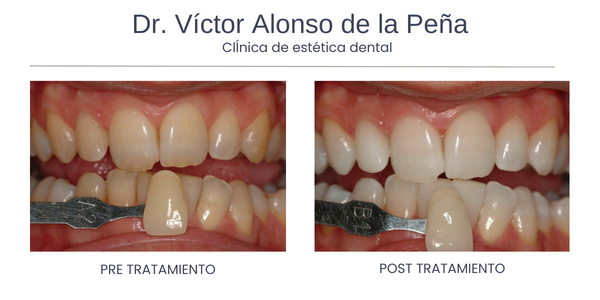 clinica-estetica-dental-galicia-blanqueamiento-nueve