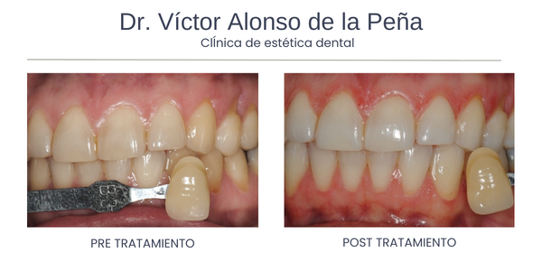 clinica-estetica-dental-galicia-blanqueamiento-ocho