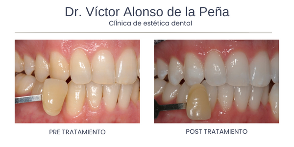 clinica-estetica-dental-galicia-blanqueamiento-seis