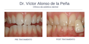 clinica-estetica-dental-galicia-blanqueamiento-siete