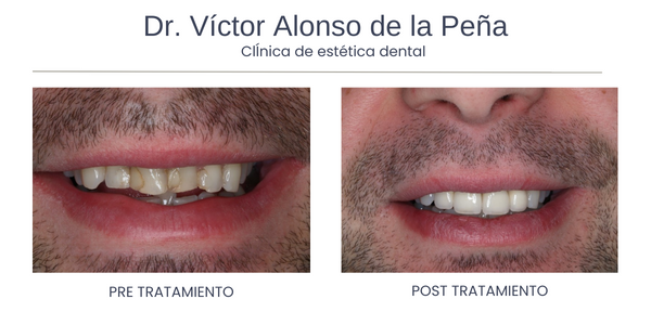 Corrección del Ronquido - Clínica Dental Víctor Alonso de la Peña