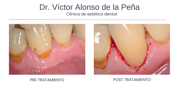 clinica-estetica-dental-galicia-lesiones-dos