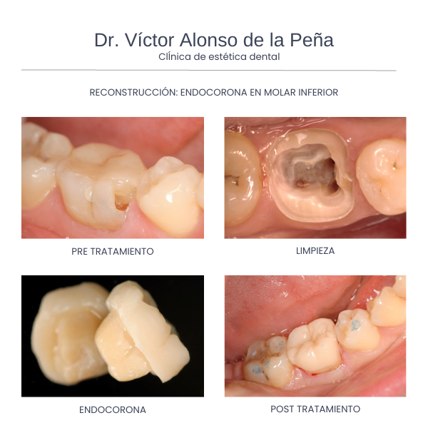 clinica-estetica-dental-galicia-reconstrucciones-dos