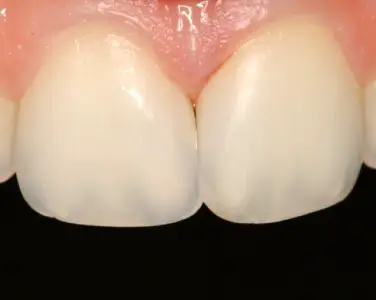 dentista-santiago-de-compostela-carillas-composite