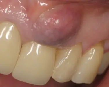 dentista-santiago-de-compostela-endodoncia