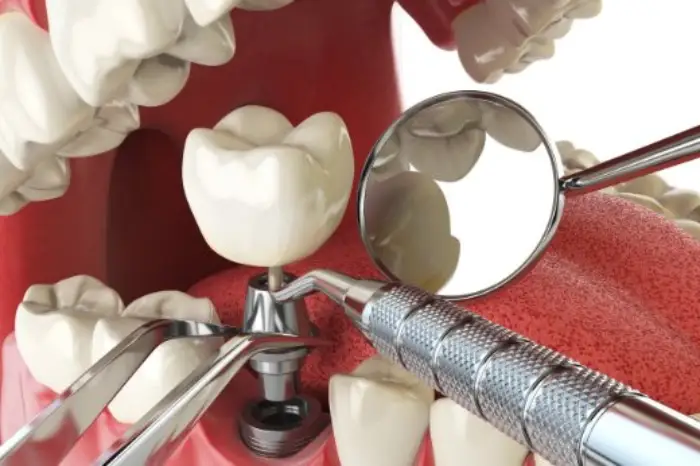 implantes-dentales-santiago-de-compostela-intro