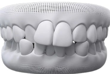 invisalign-santiago-de-compostela-apiñados