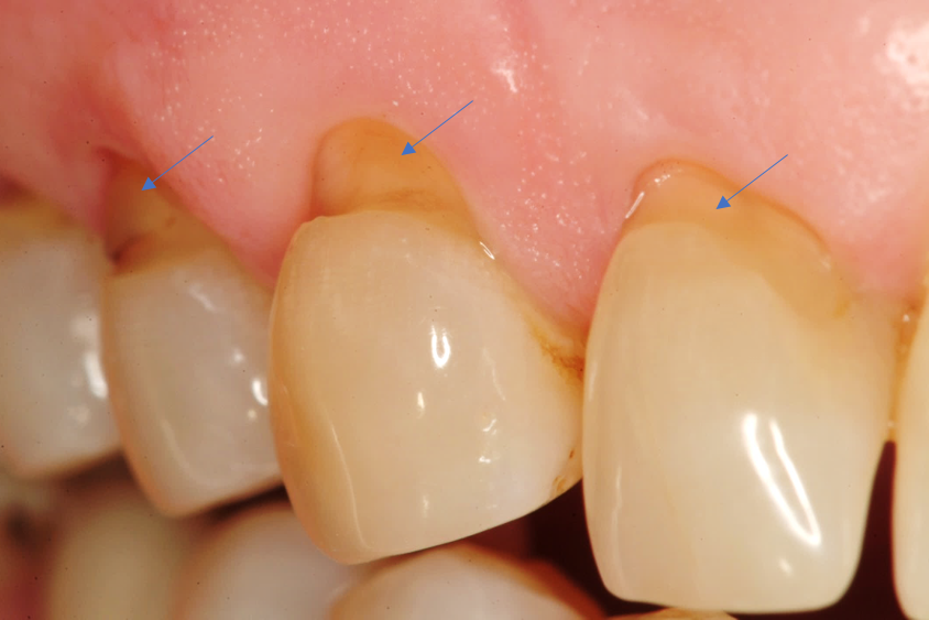 lesión cervical no cariosa