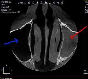 sinusitis-infeccion-dental