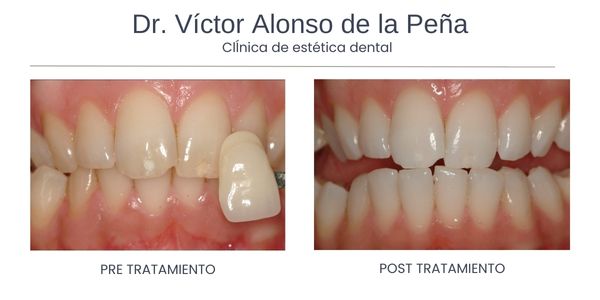 clinica-estetica-dental-galicia-blanqueamiento-siete